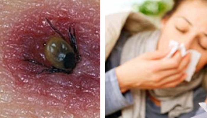Grip ile karıştırmayın: Ölümcül kene ısırığına dikkat edin! Bu semptomları görmezden gelmeyin! Özellikle bu risk alanında olanlar …