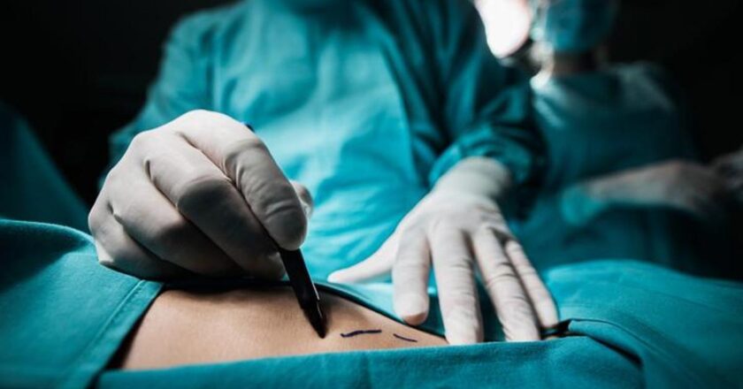 Liposuction nedir, nasıl yapılır? Liposuction tedavisi hangi durumlarda?