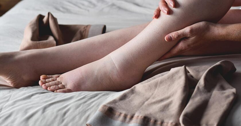 Bir ayağınız diğerinden büyükse dikkatli olun; tek taraflı şişlik lenfödem belirtisi olabilir.